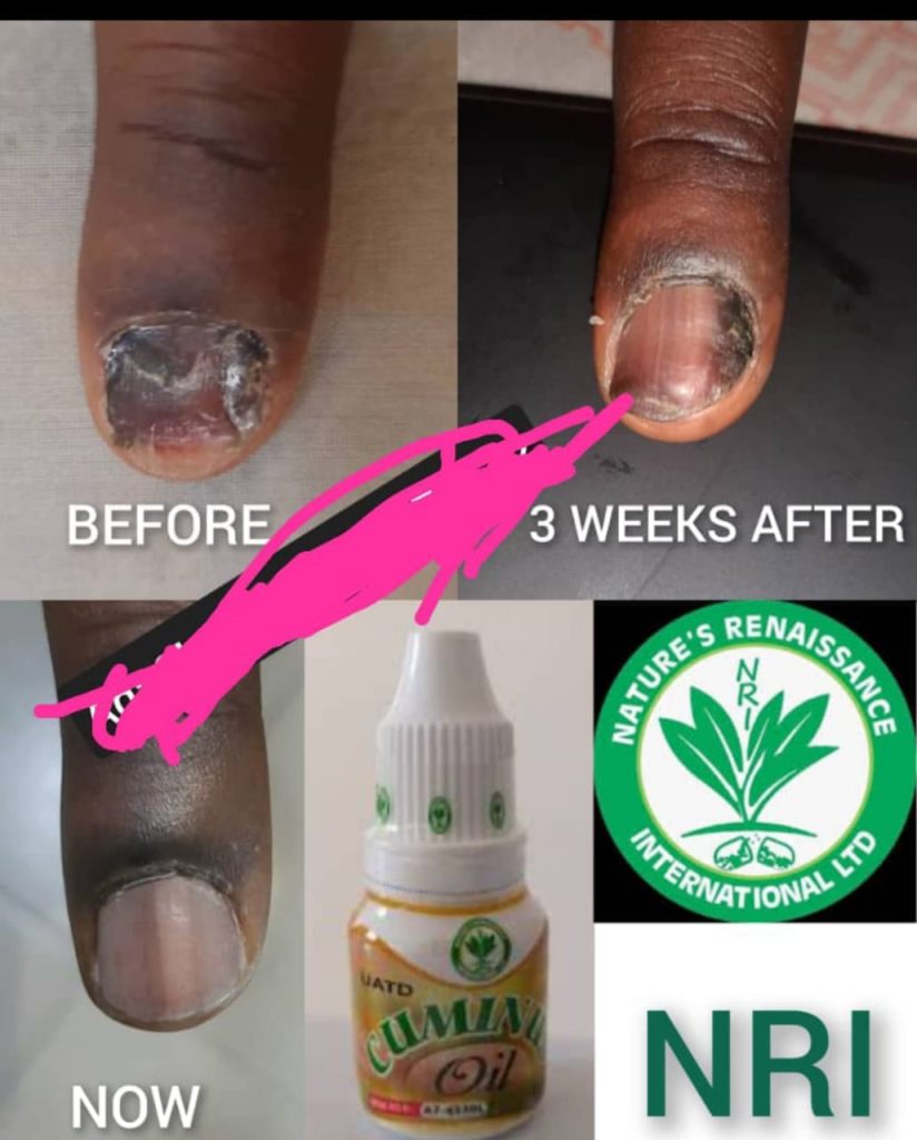 Finger-Nail-Regrowth-Testy-1.jpeg